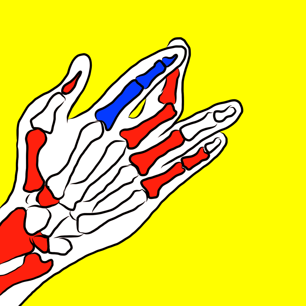 a drawing of an xray of a hand. the middle finger is dislocated