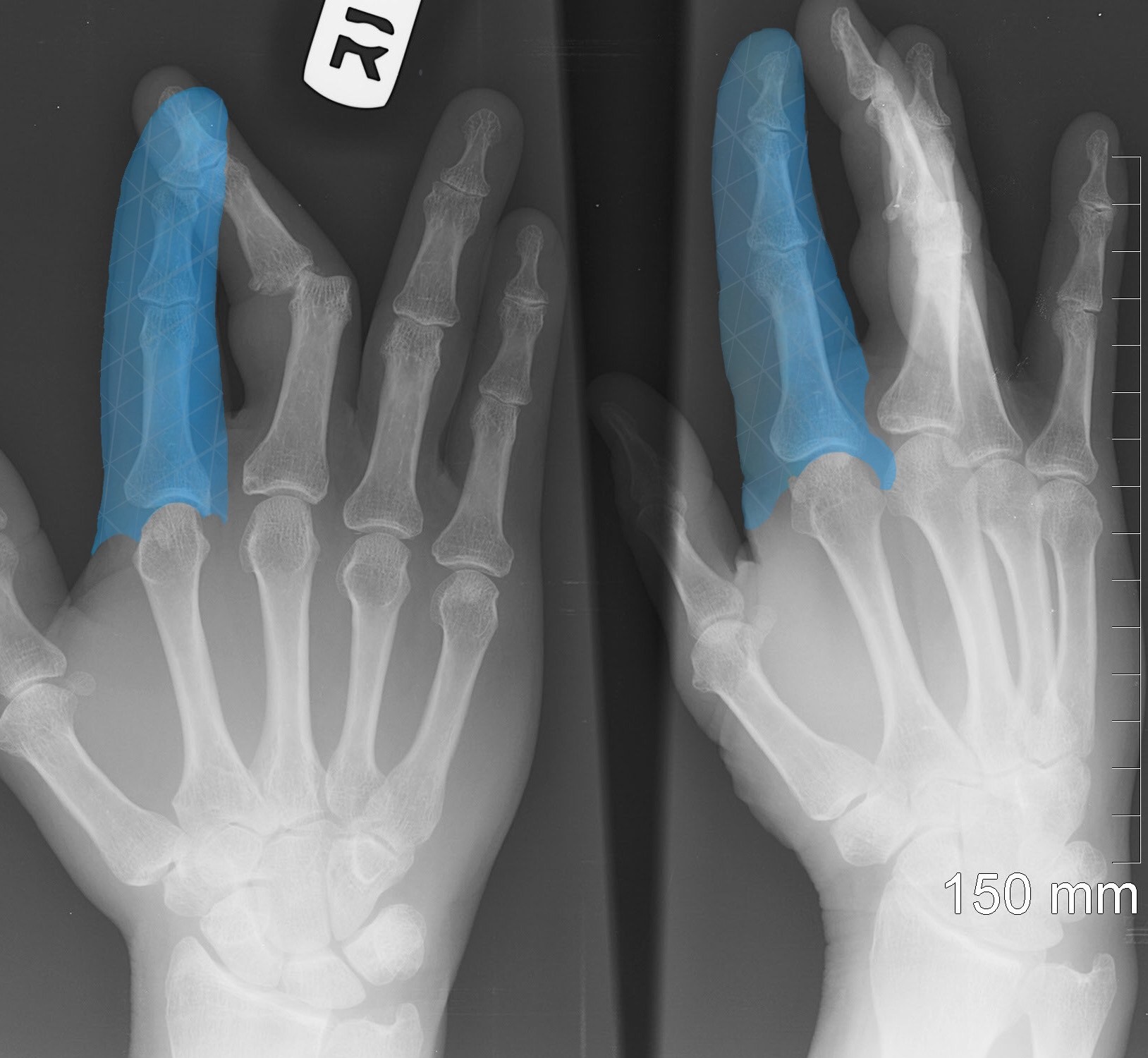 xray image of a human hand. the middle finger is dislocated at the first knuckle, and the index finger glows blue